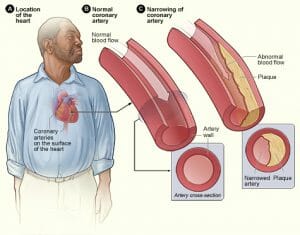 Narrowing of the coronary arteries image