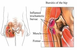 Natural hip bursitis pain relief 