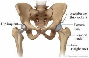 How to get rid of hip pain