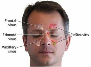 Natural Remedies for Sinusitis that are guaranteed to help