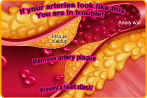 Artery plaque image