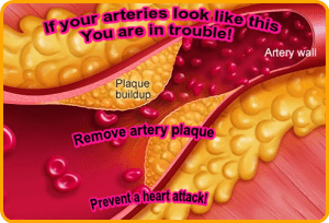 Why is Clogged Arteries so Dangerous?