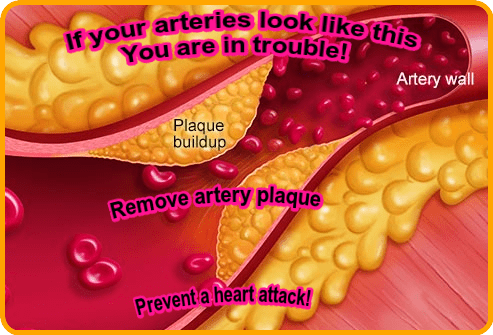 Artery plaque image