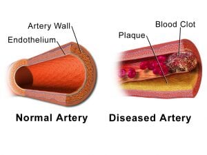 What is CHD disease blocked arteries image