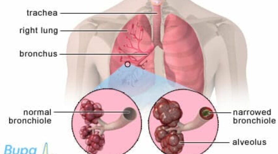 COPD Treatment Options And Tips To Improve Quality Of Life