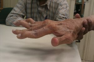 Supplements for Rheumatoid arthritis 