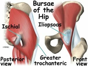Bursitis of the hip