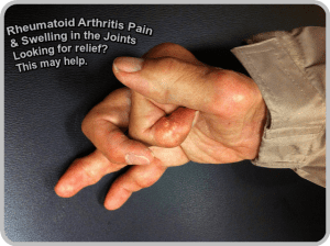 Treatment Rheumatoid arthritis hand 