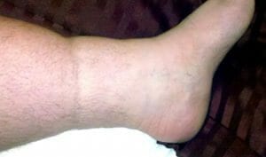 Swollen ankle