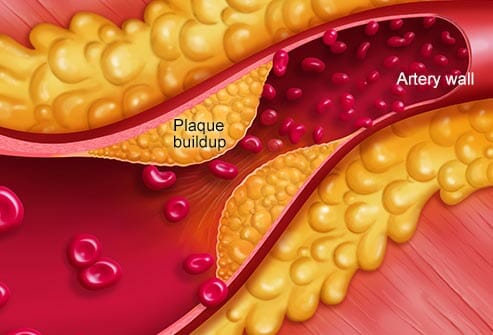 Blocked artery image