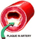 Clear artery plaque | It can be done!