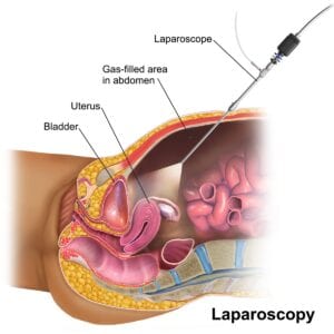 Is Serrapeptase the best endometriosis natural treatment?