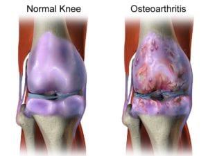 Natural pain relief for osteoarthritis in your knee