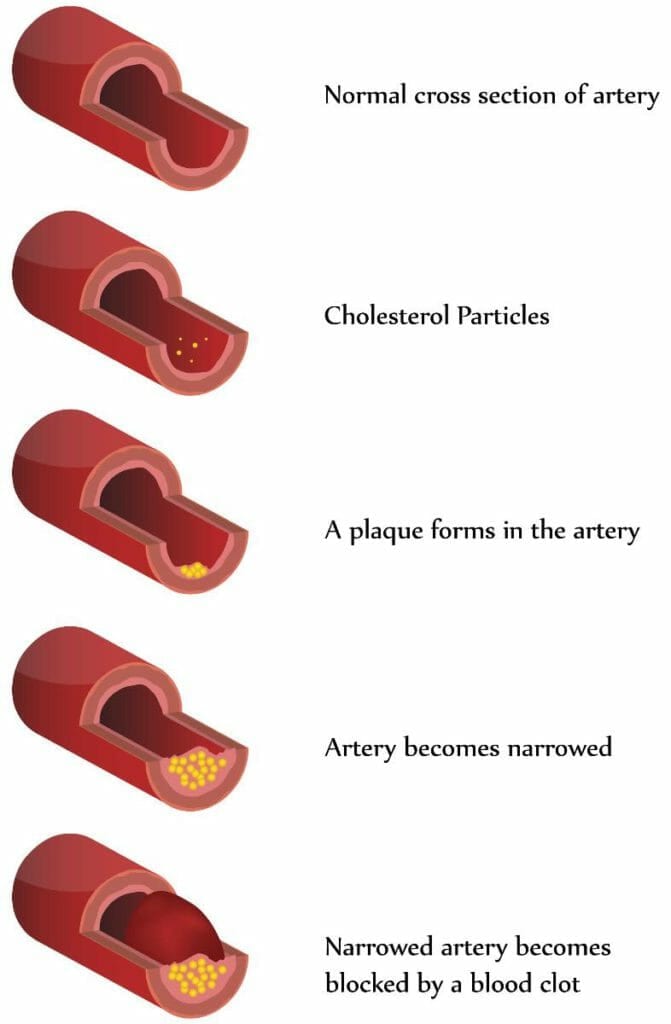 Can calcification of the arteries be reversed?