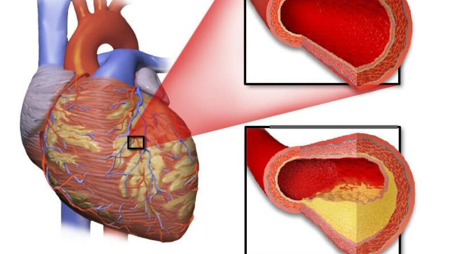 Can arteries be unclogged?