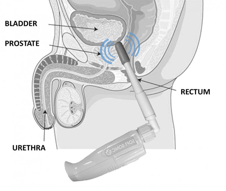 How does sonic prostate massager work