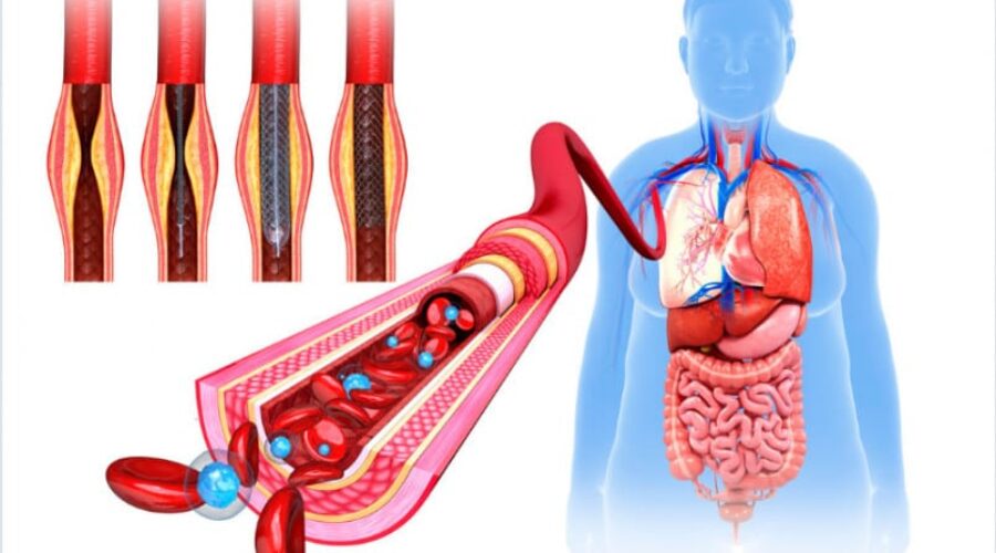 Calcification of arteries and heart health