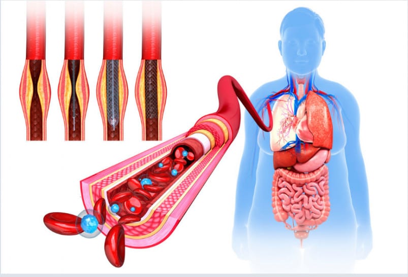 how to reduce calcification of the arteries